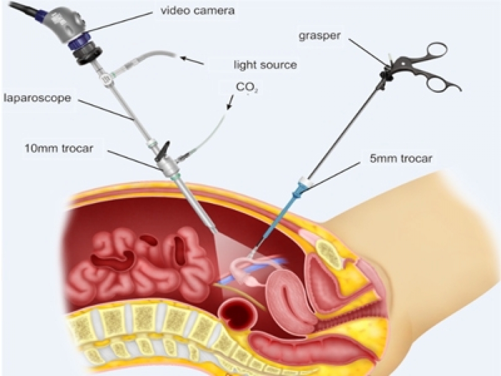 laparoskopik histerektomi ameliyatı